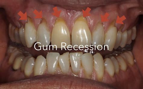 All About Receding Gums Causes Symptoms And Treatment Food And Health