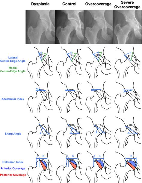 What Are The Radiographic Reference Values For Acetabular Under And