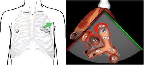 Parasternal Short Axis View Pulmonary Artery Bifurcation Image