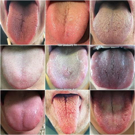 Tcm Monitoring Tongue Changes — Kenton Sefcik Rac