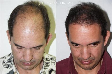 Hair Transplants For Men Photos Miami FL Patient37983