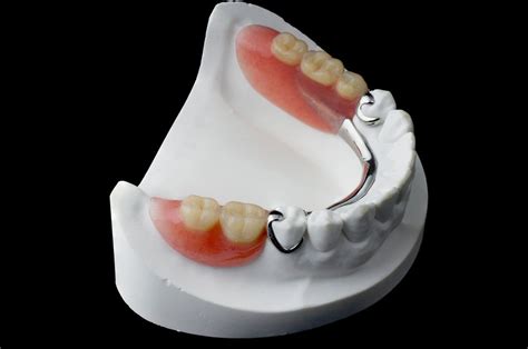 Partial Dentures Fredericksburg Va Advantage Dental Dr Paul Jiral