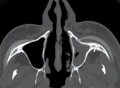 Imaging Of Silastic Cheek Implant Penetration Into The Maxillary Sinus
