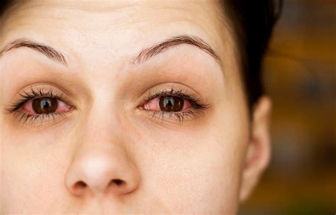 Everything You Need To Know About Chlamydial Conjunctivitis Latest