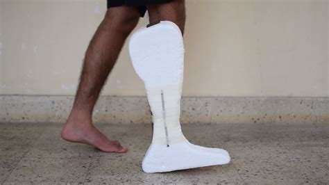Smart Prosthetic Leg Youtube