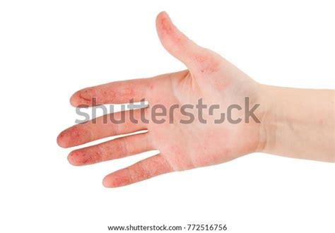 Womans Hand Wounds Eczema Dermatitis Stock Photo 772516756 Shutterstock