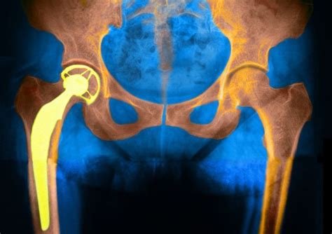 Pin On Hip Surgery