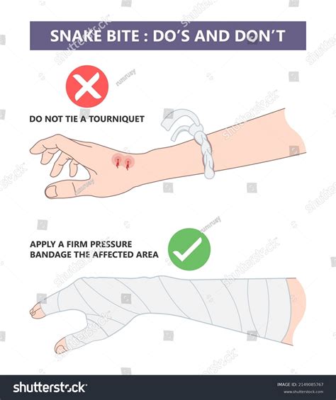 Snake Bite First Aid Care Non Stock Vector Royalty Free 2149085767