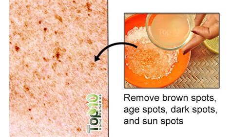 How To Get Rid Of Brown Spots On Skin Top 10 Home Remedies