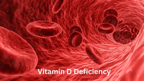 Health Benefits Vitamin D Deficiency Youtube