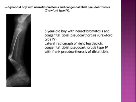 Congenital Pseudoarthrosis