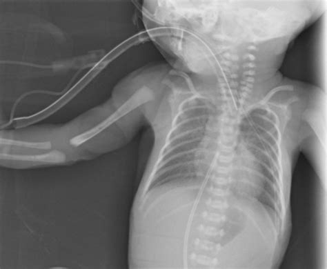 Where Is The Orogastric Tube Going In This Preterm Neonate Bmj Case