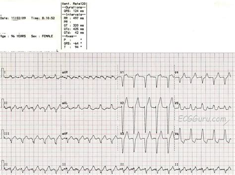 Atrial Flutter With 21 Conduction And Left Bundle Branch Block Ecg