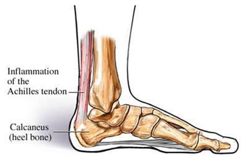 Learn more from webmd about achilles tendon injuries, including their causes, symptoms, diagnosis, treatment, and prevention. Achilles Tendinitis | Colorado Pain - Denver, Golden