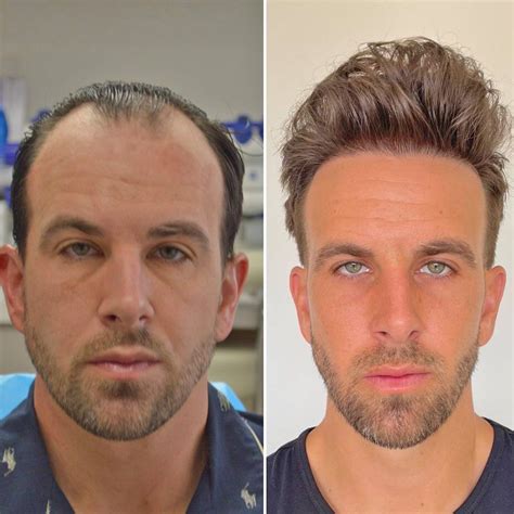 Top 48 Image Hair Transplant Before And After Vn