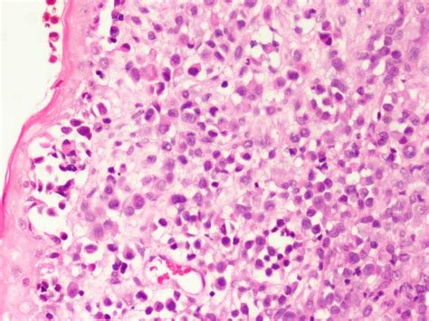 Pathology Outlines Melanoma