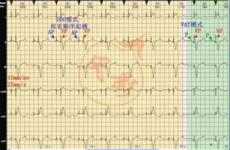 心电图图例分析：双腔起搏器DDD及VAT起搏模式 - 爱爱医医学网