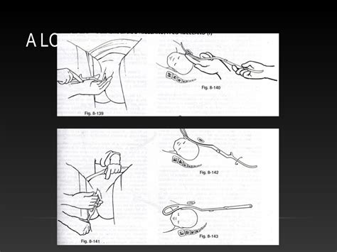 Parto Forceps Consequencias Psicologicas