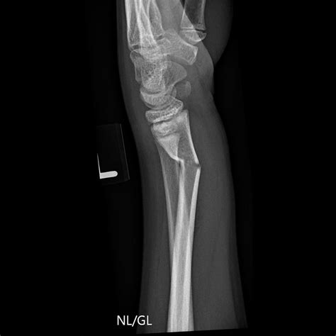 Greenstick Fracture Treatment