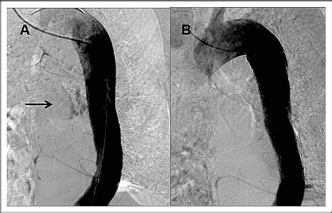 Figure 1 From Thoracic Endovascular Repair For Aorto Esophageal Fistula