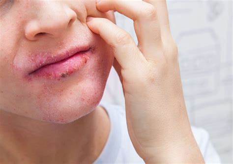 Eczema On Lips Types Symptoms Treatment And More