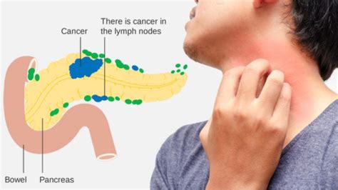 7 Warning Signs Of Pancreatic Cancer Everyone Should Know About