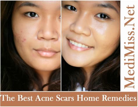Best Remedies For Acne Scars Treating Acne With Diet