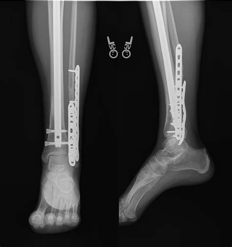 In rare cases, external fixation or orif is more appropriate radiographs of the tibia and fibula are provide in figures a and b. Nonunion: Tibia Case 6 - Dr. Mark Brinker, Houston ...