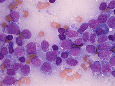 Nk T Cell Lymphoma Is A Highly Aggressive Cancer Of A Specific Type Of
