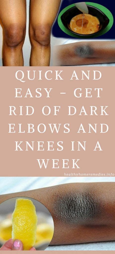 Quick And Easy Get Rid Of Dark Elbows And Knees In A Week Healthy