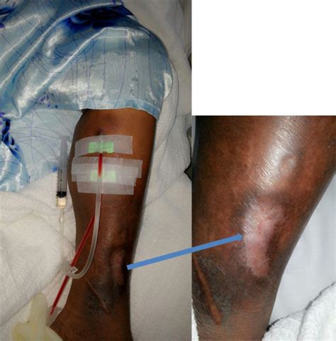 Left Ankle Arteriovenous Fistula Avf During Hemodialysis With Healed
