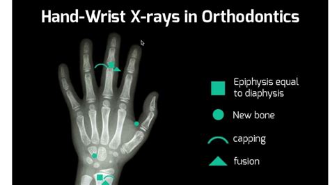 How To Read A Hand Wrist Xray For Orthodontics Straightsmile Solutions Method Youtube
