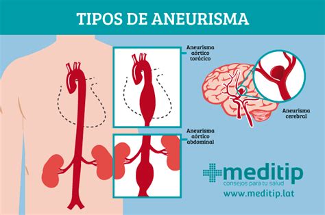 Aneurisma Ou Aneurisma Tipos Fisiopatologia Causas Sintomas Sexiz Pix