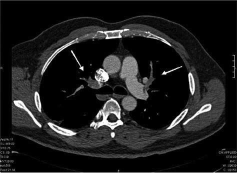 Angio Ct Demonstrating A Massive Bilateral Pulmonary Thromboembolism