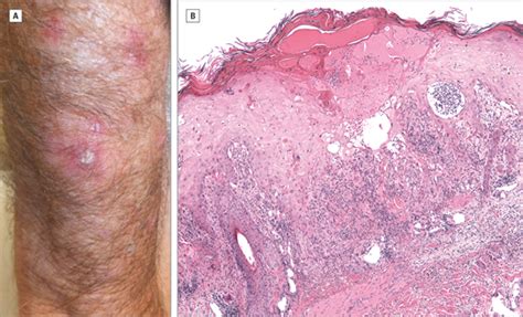 Erythematous Papules On The Forearms Dermatology Jama Dermatology