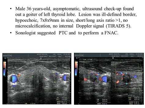 Vietnamese Medic Ultrasound Case Thyroid Nodule Or Ptc Dr Le