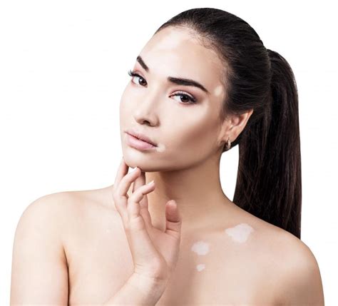 Look For These 5 Common Signs Of Vitiligo Easton Dermatology