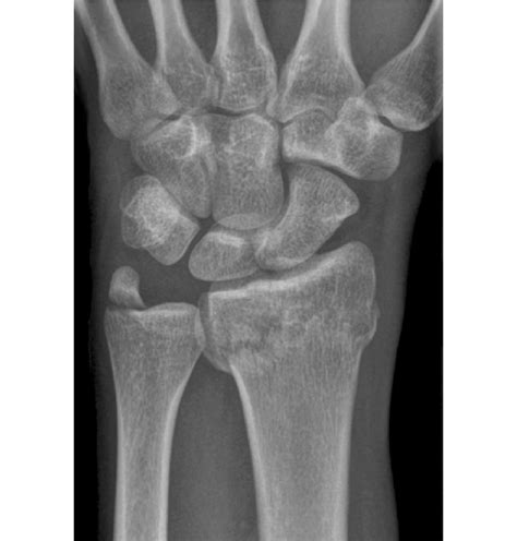 Dorsal Palmar X Ray Of The Wrist Comminuted Distal Radius Fracture