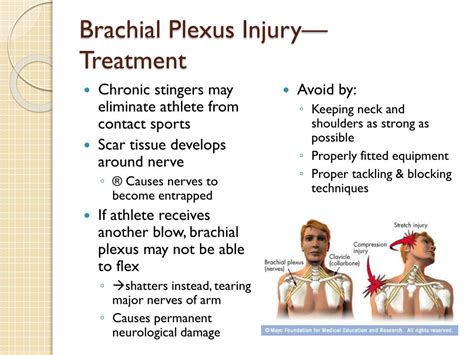 Brachial Plexus Injuries Symptoms Causes Prevention Shoulder Pain My