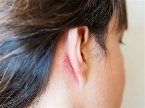 Irritation On The Skin Behind The Ear Man With Flaky Skin Allergy Or
