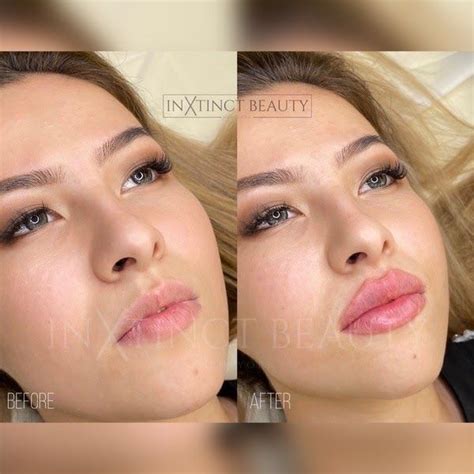 Facial Fillers Lip Fillers Filler Injection Lips Nyc Face
