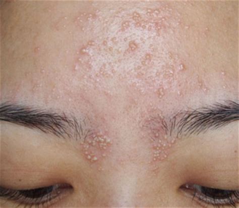 It should clear up in a few weeks without treatment. Heat Bumps, on Face, Forehead, Rash, Itchy, Get Rid ...