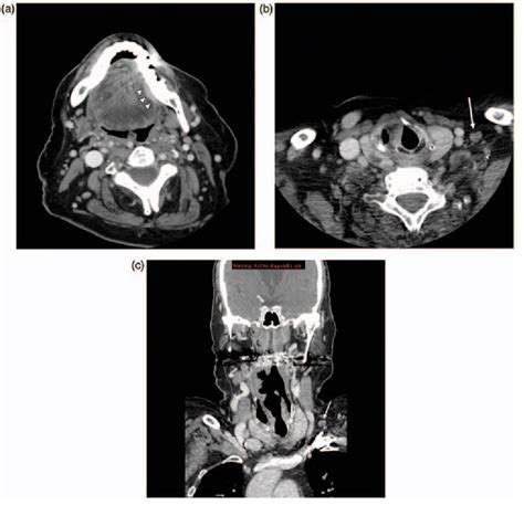 Figure 1 From The Prevalence Of Lymph Node Metastases In Clinically N0