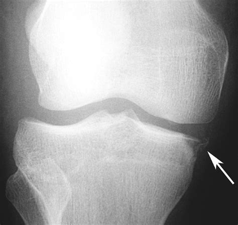 Avulsion Fractures Of The Knee Imaging Findings And Clinical Significance RadioGraphics
