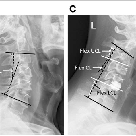 Measurement Of Cervical Alignment And Radiological Parameters A