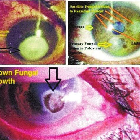 Pdf Visual Outcome In Patients Of Keratomycosis At A Tertiary Care