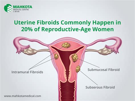Women Uterine Fibroid Diagnosis And Screening Mahkota Medical Centre