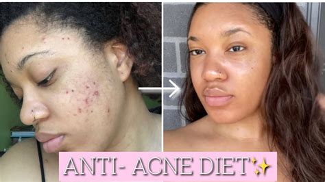How I Cured My Hormonal Acne With My Diet The Best And Worst Foods For