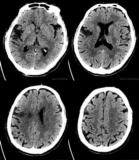 Intra Arterial Tpa For Acute Ischemic Stroke