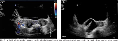 figure 3 from isolated fallopian tube torsion in prepubertal females a report of 2 cases